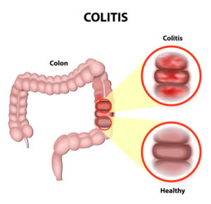 Ulcerative colitis is a chronic disease that results in inflammation of the colon's innermost layer.