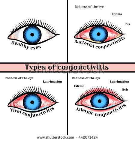 stock-vector-conjunctivitis-types-inflammatory-diseases-of-eyes-442671424